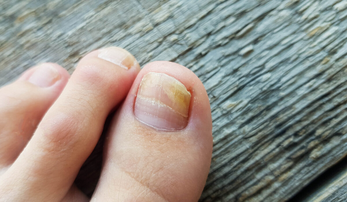 Dites adieu aux mycoses des ongles pour toujours grâce à un ingrédient peu coûteux